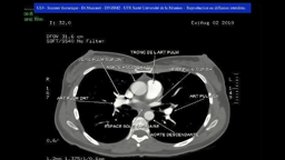 DFGSM2_UE4.S3-15 Radiographie thoracique et tomodensitometrie (2)_P. MASCAREL