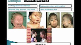 PACES_UEsp MEDECINE-C12 Syndrome d'alcoolisation foetale (2)_B.DORAY