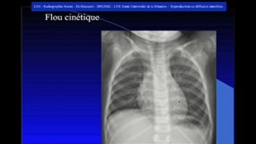 DFGSM2_UE4.S3-14 Radiographie thoracique (1)_P. MASCAREL